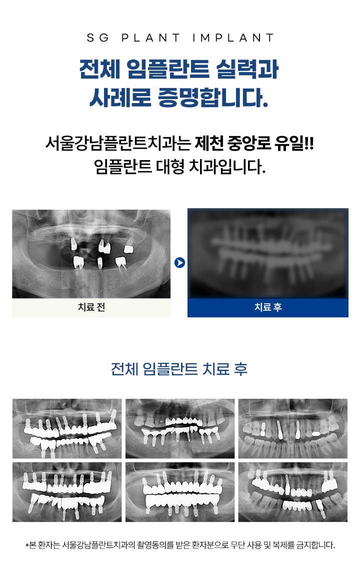 서울강남플란트치과 전악풀케이스 임플란트 전후 사진. 고혈압, 당뇨 등 기저질환자도 안전한 임플란트 수술 가능.