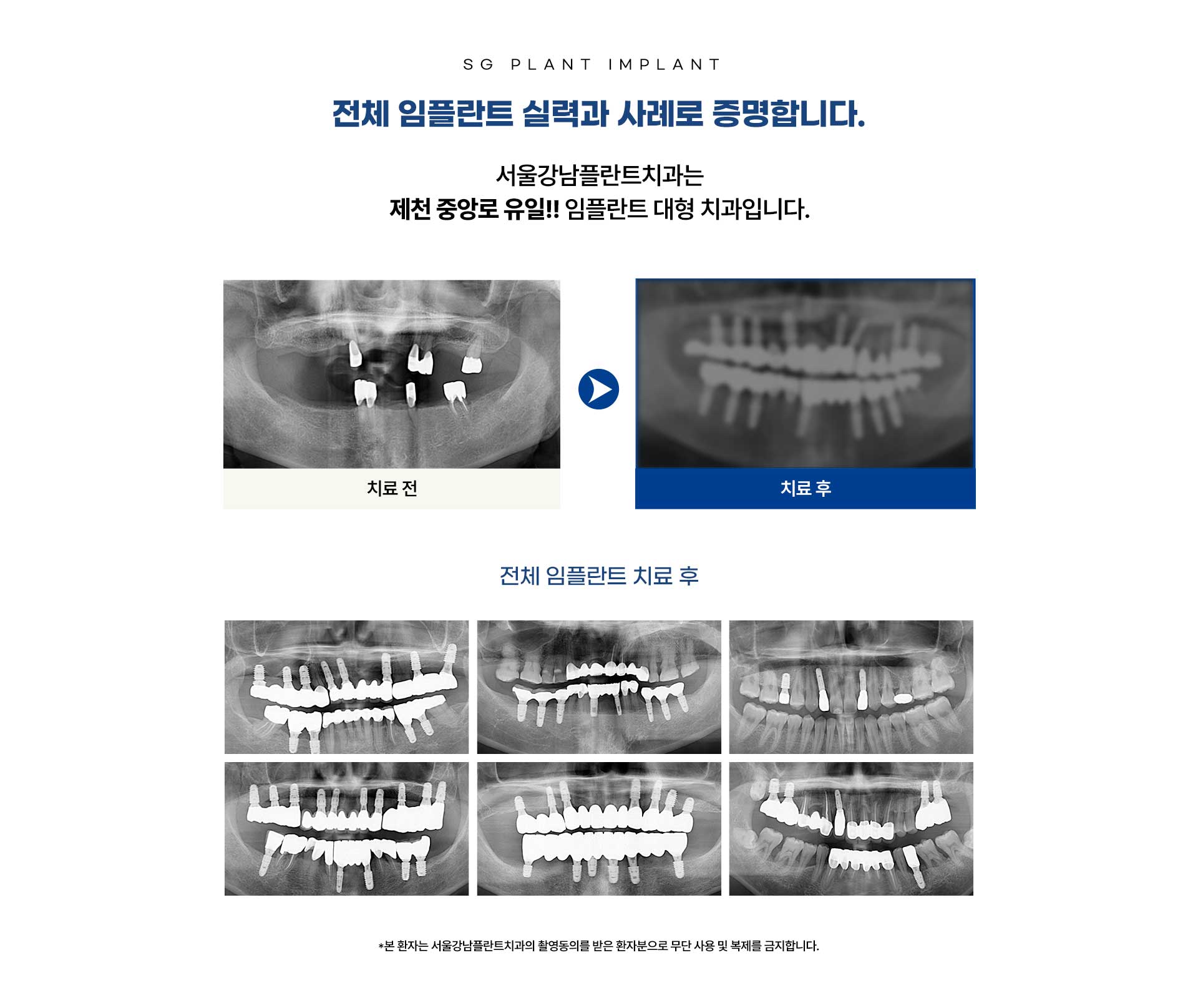 서울강남플란트치과 전악풀케이스 임플란트 전후 사진. 고혈압, 당뇨 등 기저질환자도 안전한 임플란트 수술 가능.