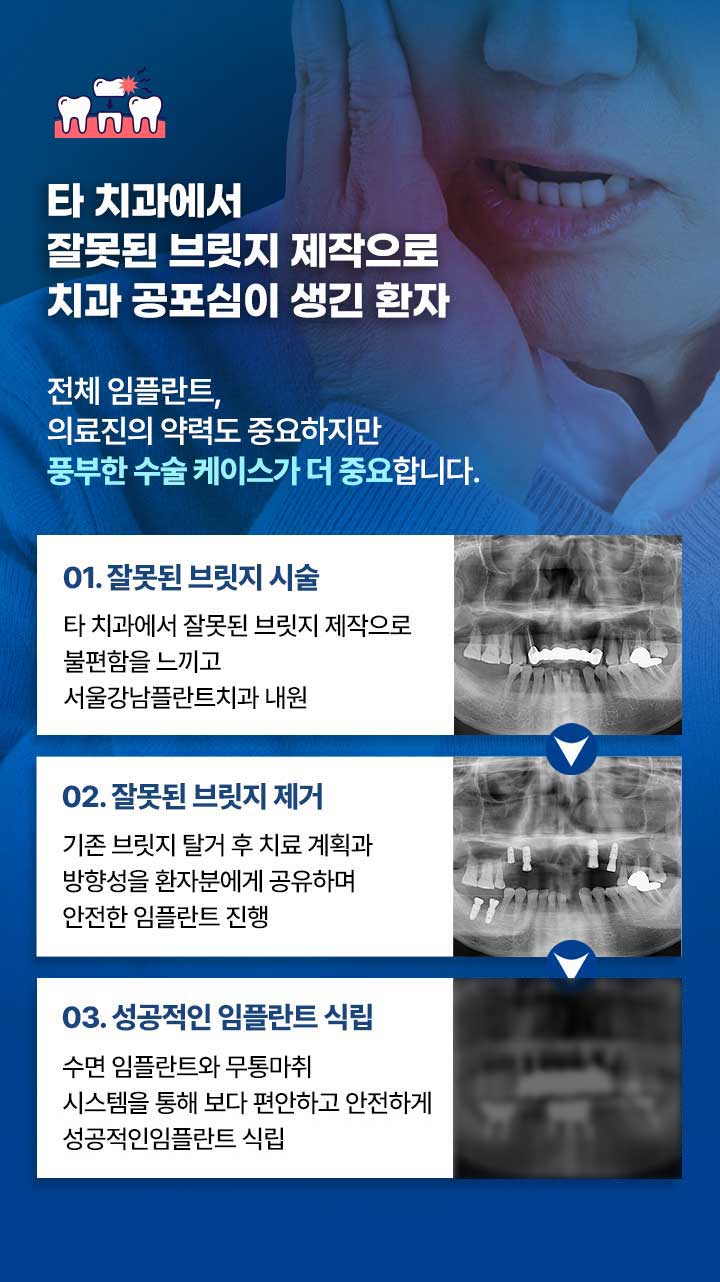 잘못된 브릿지 시술로 내원한 환자, 서울강남플란트치과에서 수면 임플란트와 무통마취로 성공적인 임플란트 식립 완료.