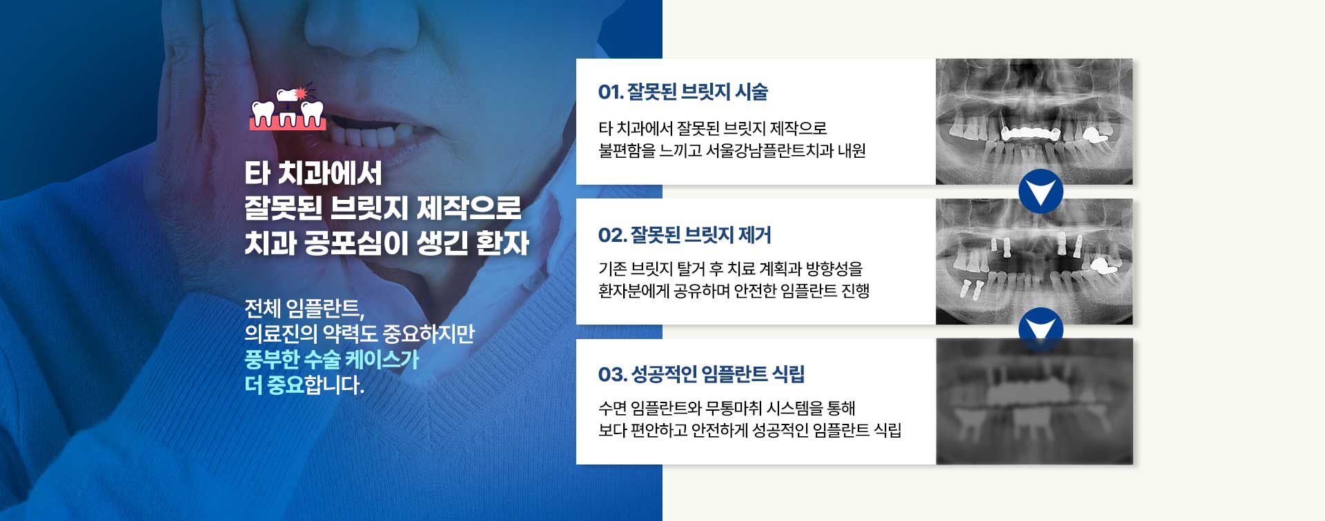 잘못된 브릿지 시술로 내원한 환자, 서울강남플란트치과에서 수면 임플란트와 무통마취로 성공적인 임플란트 식립 완료.