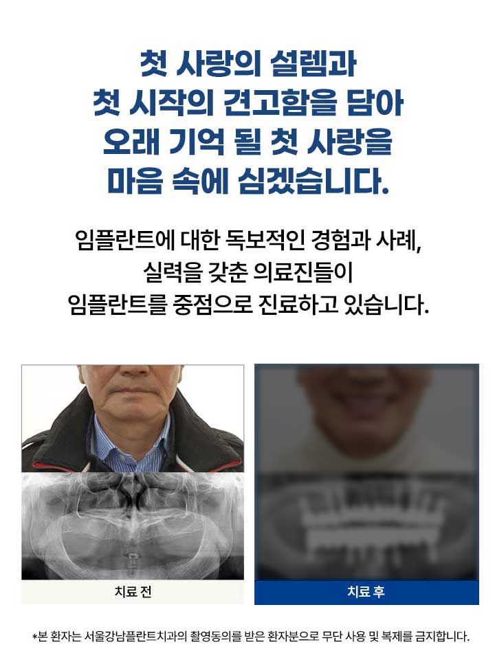서울강남플란트치과, 전악임플란트 식립 전후 사진. 통합치의학 전문의와 경험 많은 의료진이 직접 진료.