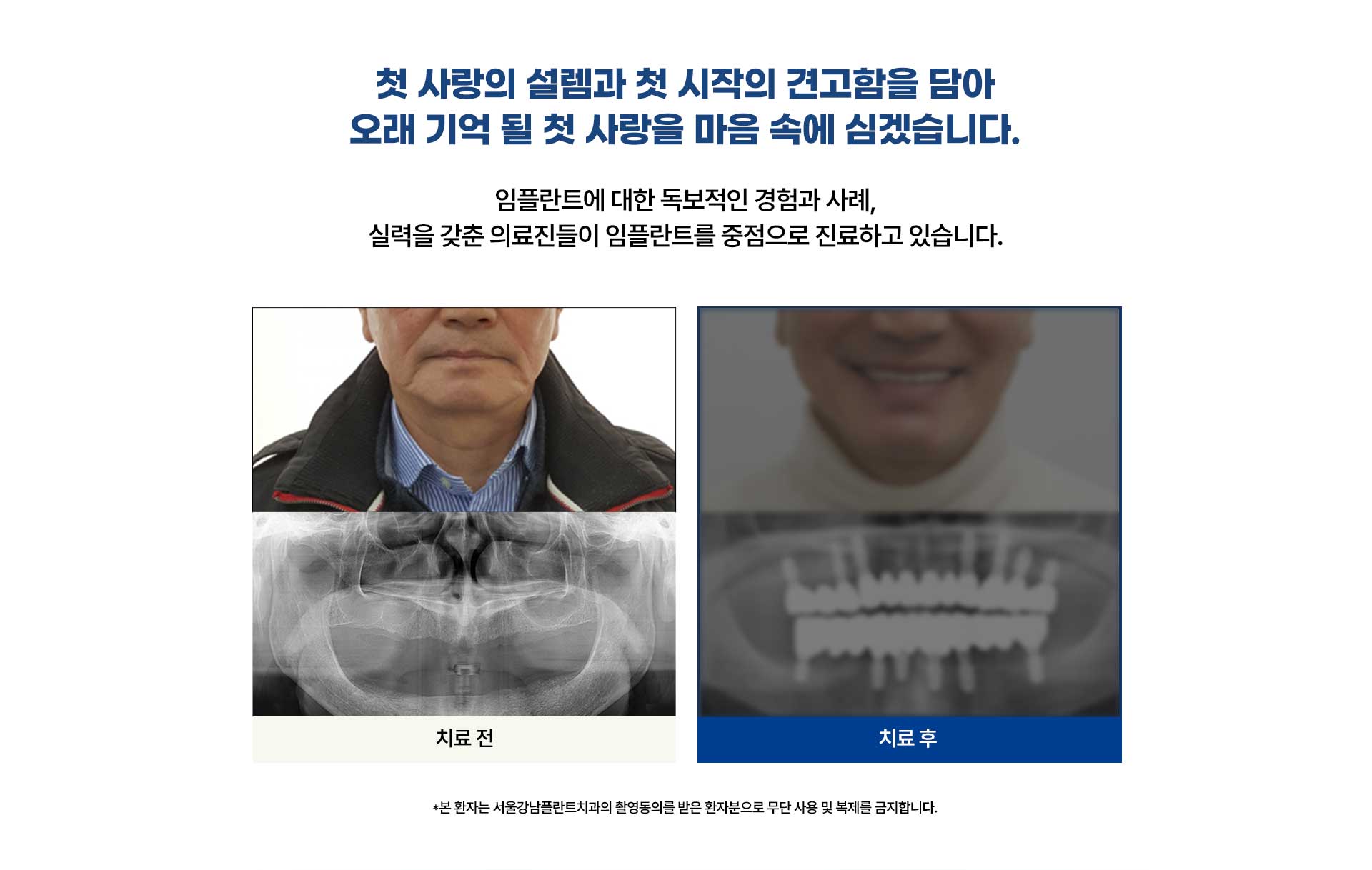 서울강남플란트치과, 전악임플란트 식립 전후 사진. 통합치의학 전문의와 경험 많은 의료진이 직접 진료.